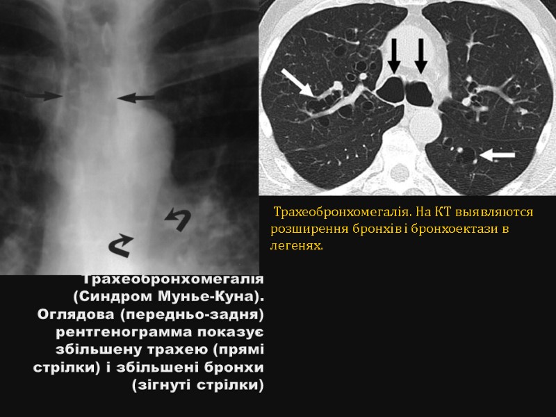 Трахеобронхомегалія (Синдром Мунье-Куна). Оглядова (передньо-задня) рентгенограмма показує збільшену трахею (прямі стрілки) і збільшені бронхи